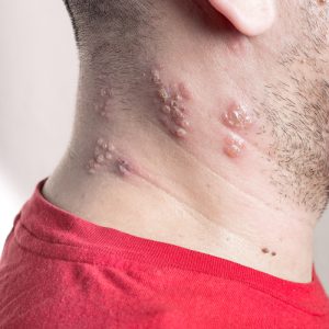 how long after starting acyclovir are you contagious shingles
